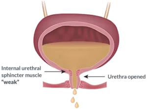 bladder illustration showing weakened pelvic floor muscles